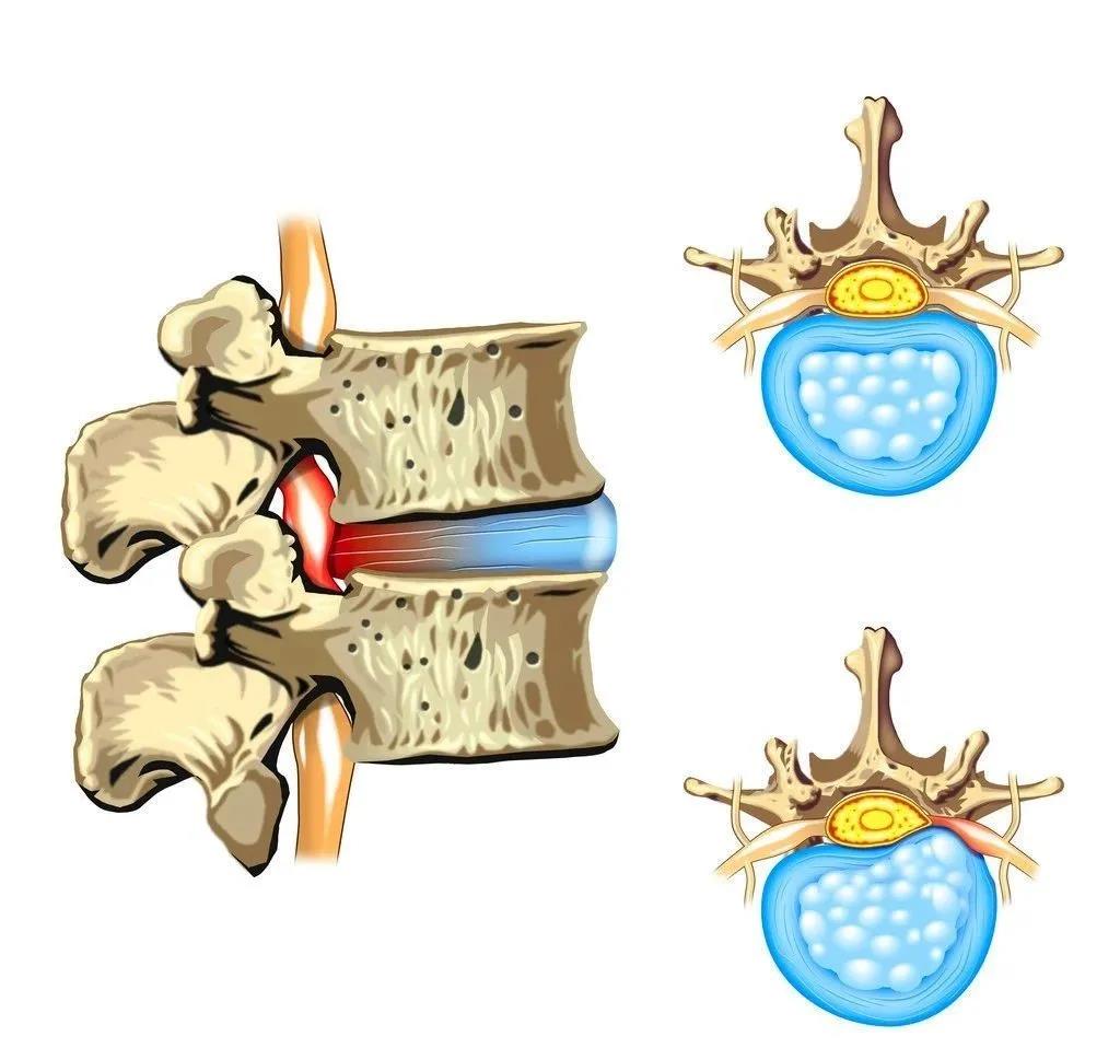 腰椎突出和膨出哪个更严重？腰椎间盘突出和膨出的区别 - 知乎